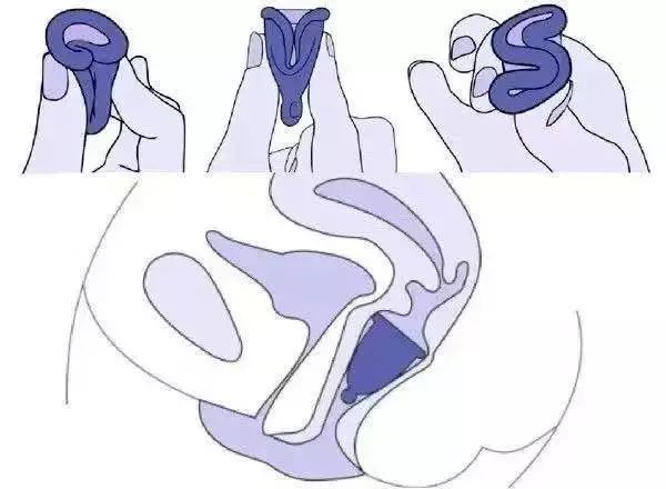 贴避孕_贴避孕地方可以同房吗_避孕贴可以贴同一个地方吗