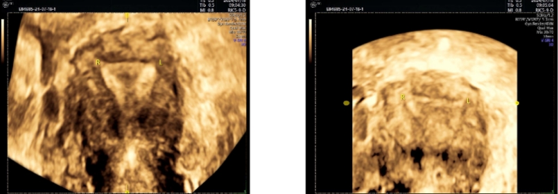 贴避孕贴后月经淋漓不尽_避孕贴 血块_贴避孕贴流血不止