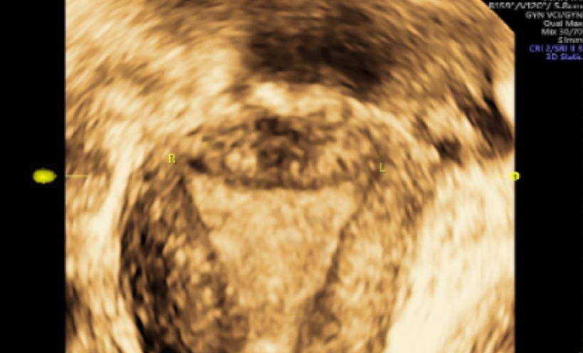 避孕贴 血块_贴避孕贴流血不止_贴避孕贴后月经淋漓不尽