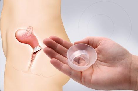 女性避孕方式统计_避孕贴多久可以行房_宫内节育器避孕比例