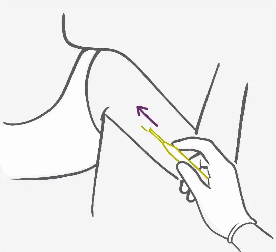 女性永久避孕方法_节育环副作用_避孕贴