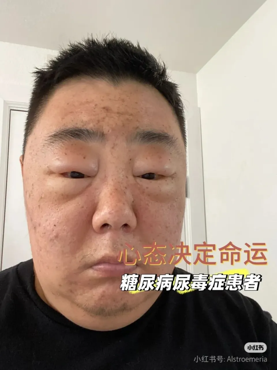 糖尿病最后的结局__糖尿病结局很惨吗