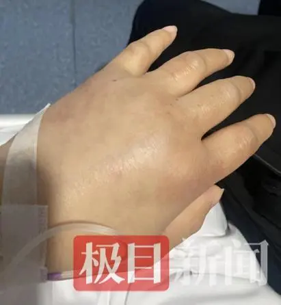 全身浮肿肾衰有什么急救办法__肾脏衰竭全身水肿能活多久