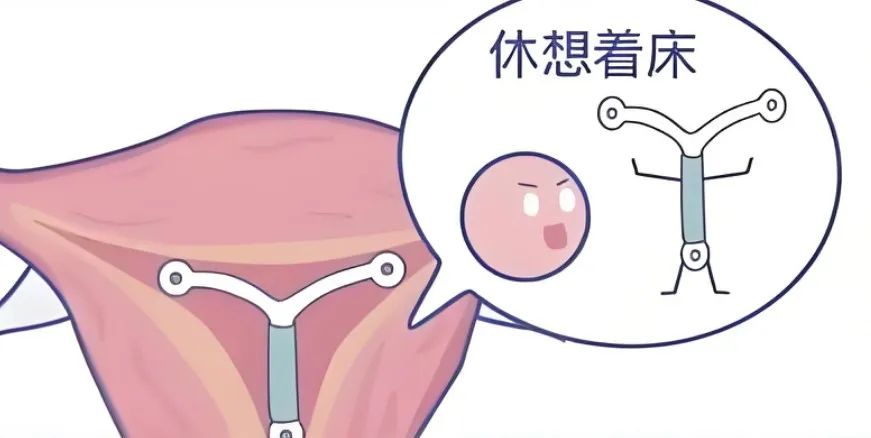 避孕贴可以贴同一个地方吗_曼月乐环避孕原理_曼月乐环适用人群