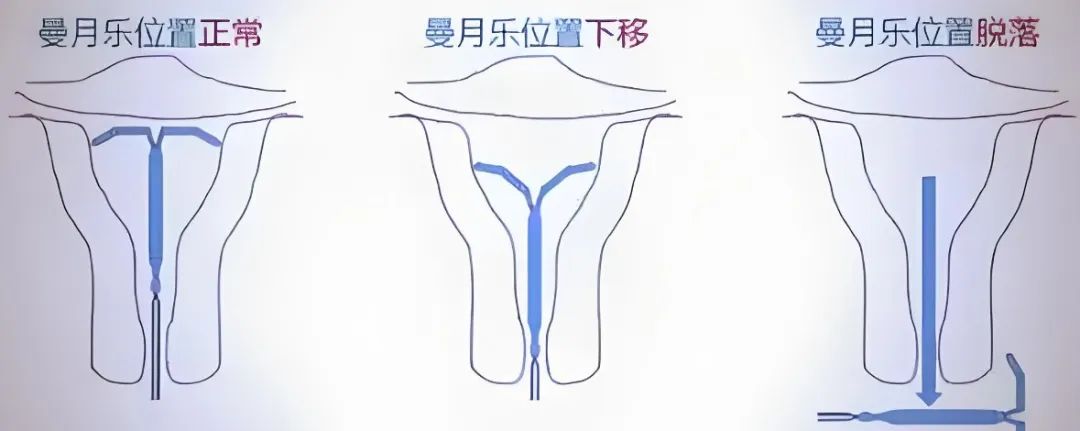 避孕贴可以贴同一个地方吗_曼月乐环避孕原理_曼月乐环适用人群