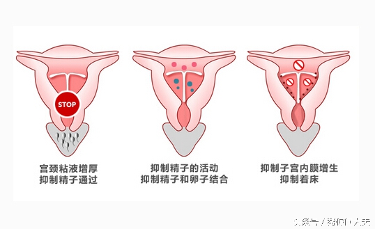 人流后上环好处_宫内节育器放置时间_避孕贴多久可以行房
