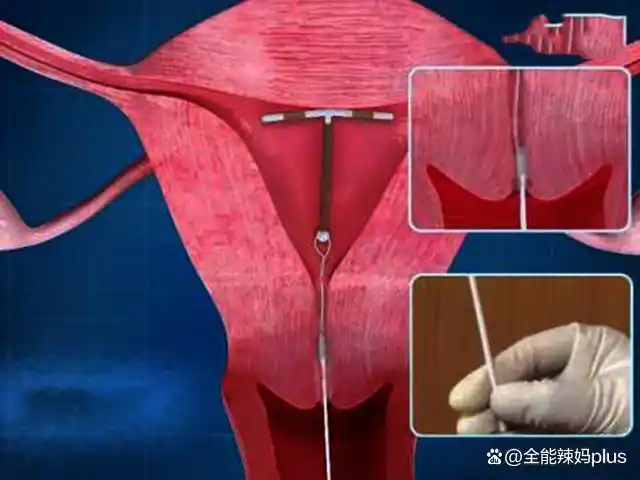 避孕贴跟避孕药_不同国家避孕习惯_婚后避孕方式