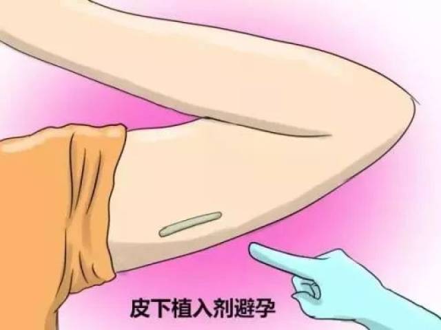 皮下埋植剂避孕效果_皮下埋植避孕术_避孕贴多久可以行房