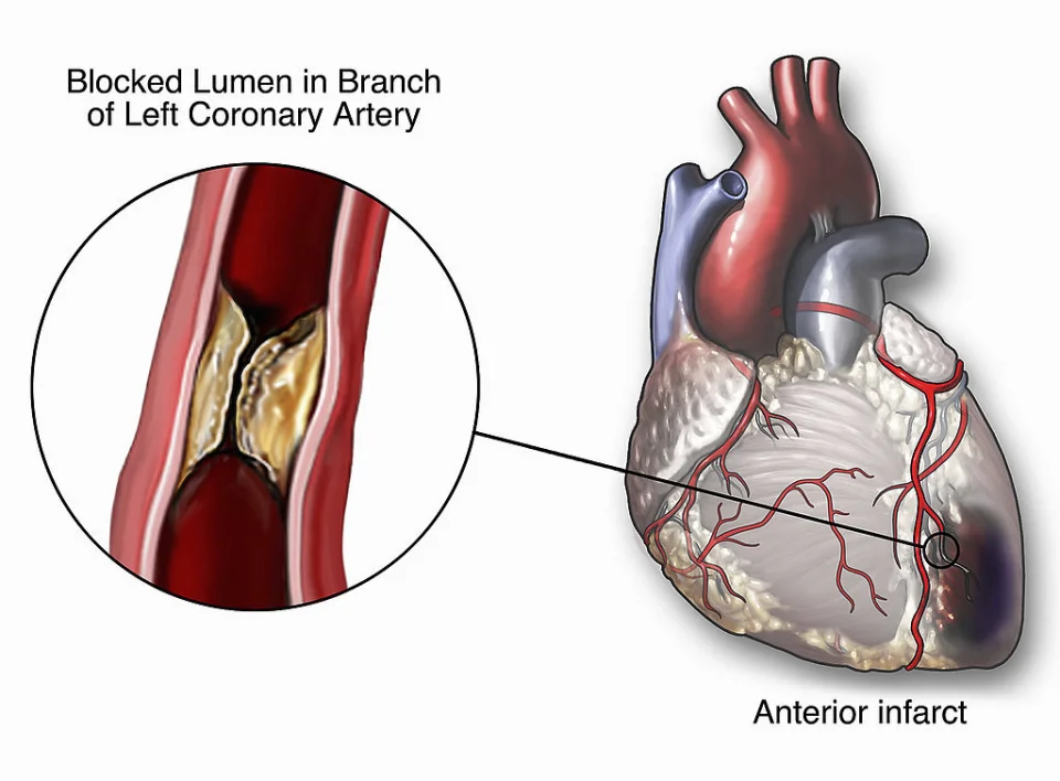心脏造影手术失误案例_心脏造影意外_