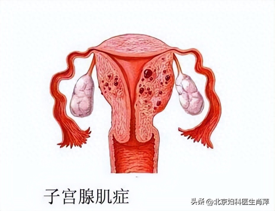 避孕贴厂家_曼月乐专利固定技术_曼月乐脱落原因分析