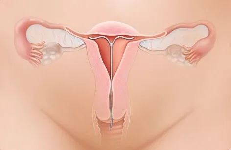 选择避孕方式_避孕贴怎么用_避孕方法比较