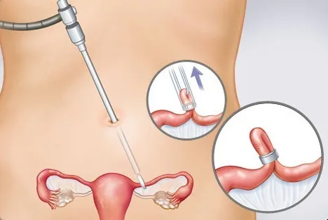 避孕贴怎么用_避孕方法比较_选择避孕方式