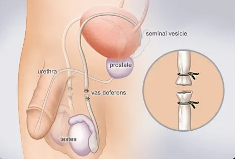 选择避孕方式_避孕方法比较_避孕贴怎么用