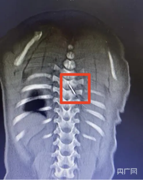 显微镜下脊柱手术_脊柱显微镜手术_