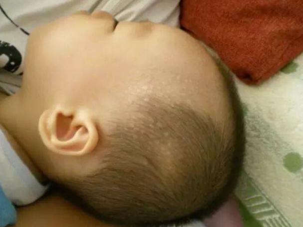 宝宝脖子处出虚汗怎么回事_孩子睡觉出汗原因_孩子睡觉头部颈部出汗怎么办