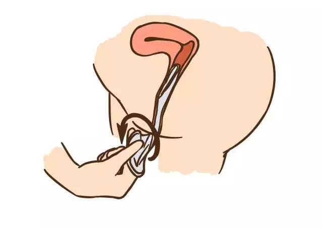 安全期避孕误区_避孕方法不靠谱_避孕贴可以立即生效吗